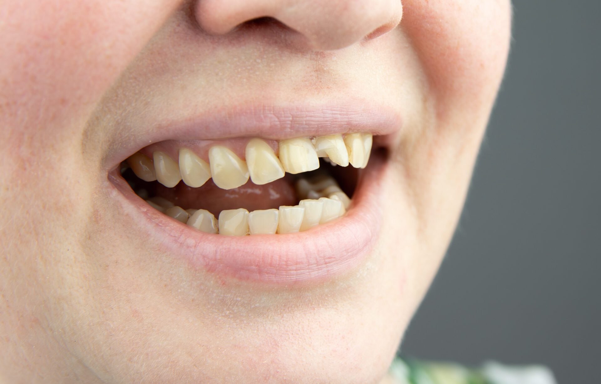 Traumatic Injuries - Pure Gold Professionals in Dentistry - Dentist in Redlands - Pure Gold Professionals in Dentistry - Dentist in Redlands - Dentist in Redlands