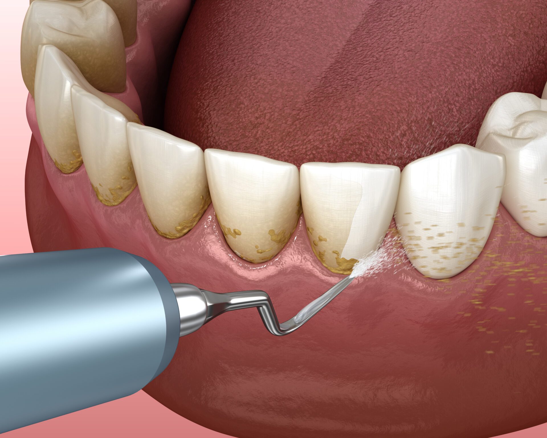 Ultrasonics - Pure Gold Professionals in Dentistry - Dentist in Redlands - Pure Gold Professionals in Dentistry - Dentist in Redlands - Dentist in Redlands
