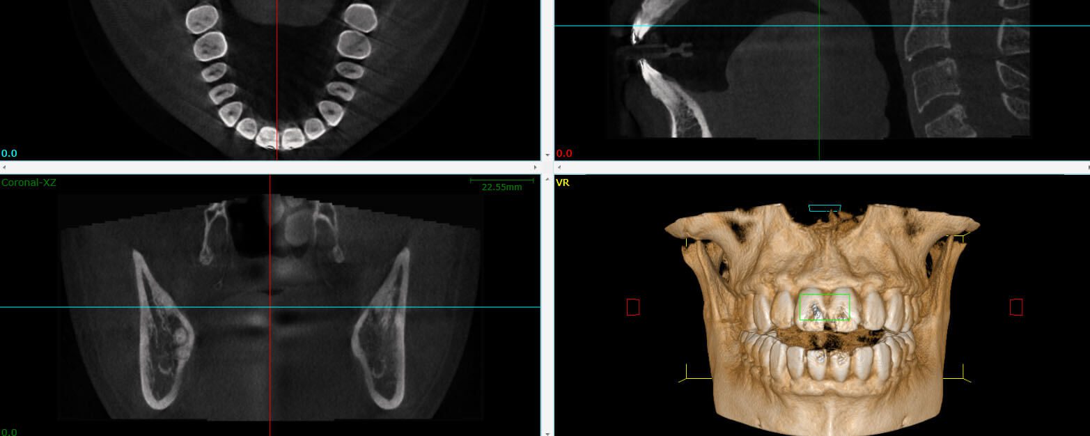 Cone Beam 3D Imaging - Pure Gold Professionals in Dentistry - Dentist in Redlands - Cone Beam 3D Imaging dentist in redlands