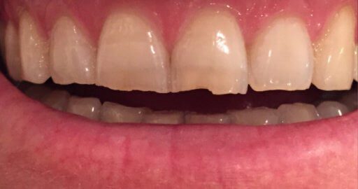 Cracked Teeth - Pure Gold Professionals in Dentistry - Dentist in Redlands - Pure Gold Professionals in Dentistry - Dentist in Redlands - Dentist in Redlands