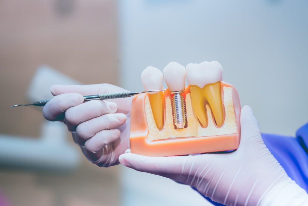 Enhancing Smiles With Dental Implants in Redlands, CA - Pure Gold Professionals in Dentistry - Dentist in Redlands - dental implants in Redlands, CA
