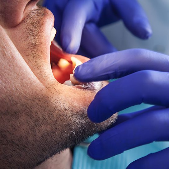 Dental Cleanings - Pure Gold Professionals in Dentistry - Dentist in Redlands - dentist cleanings