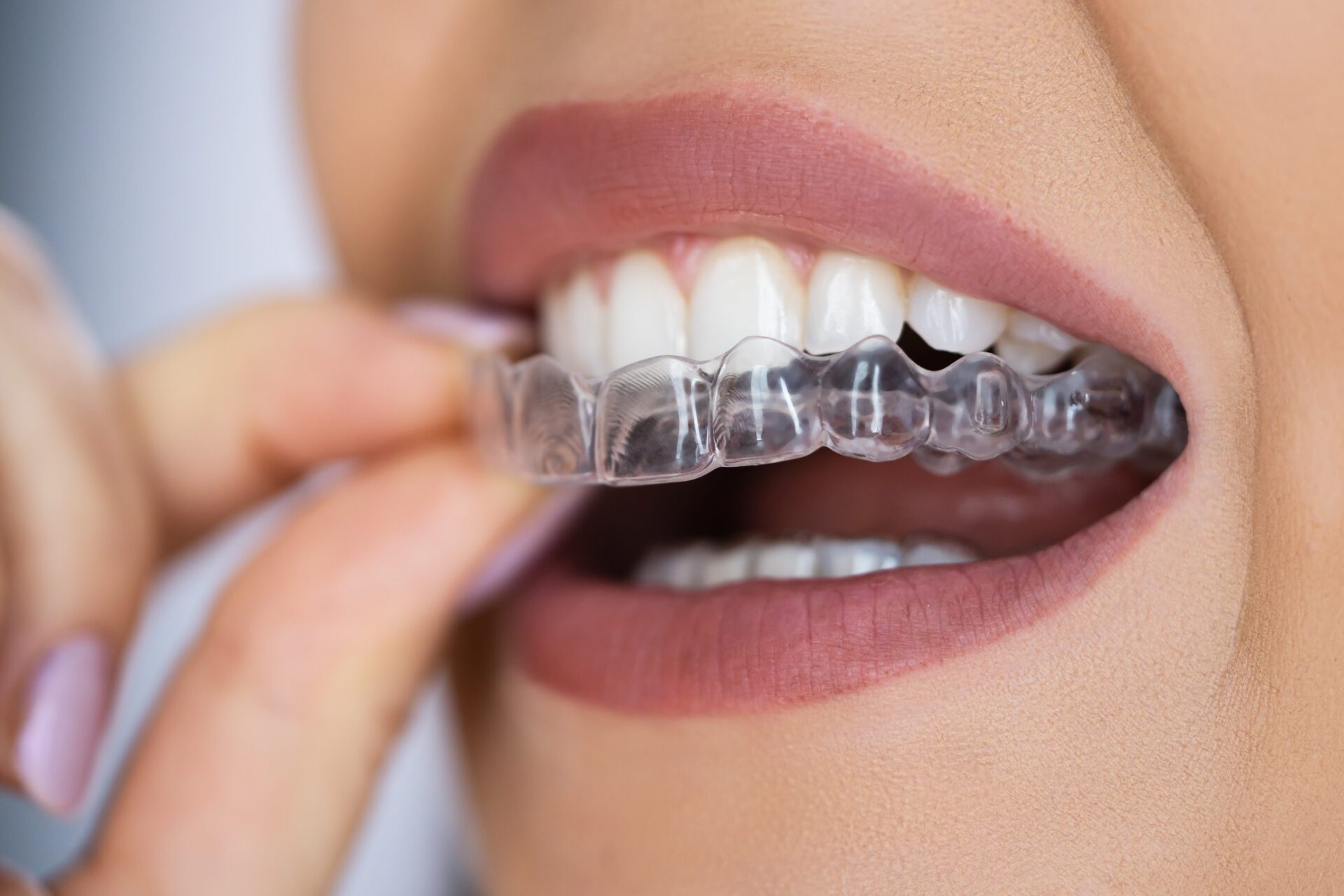 Retention - Pure Gold Professionals in Dentistry - Dentist in Redlands - Pure Gold Professionals in Dentistry - Dentist in Redlands - Dentist in Redlands