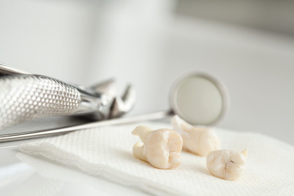 Tooth Extractions - Pure Gold Professionals in Dentistry - Dentist in Redlands - Pure Gold Professionals in Dentistry - Dentist in Redlands - Dentist in Redlands